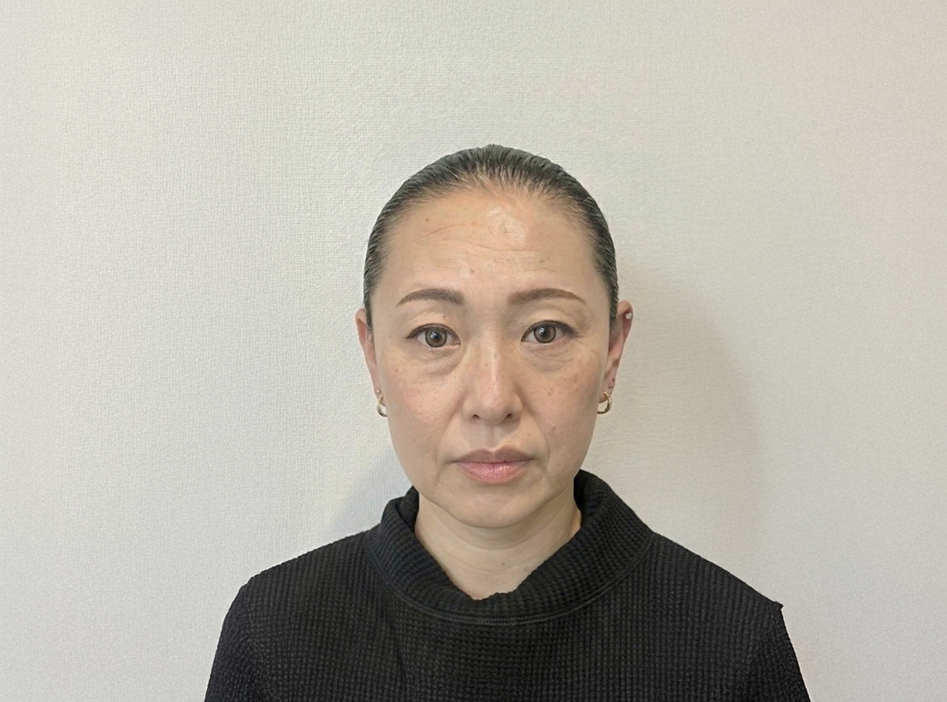 Case 03 Before ─ 30代女性・施術前